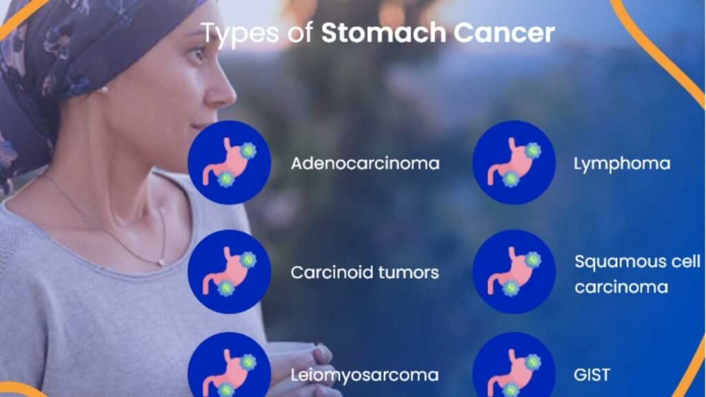 Exploring the Various Types of Stomach Cancer types of stomach cancer